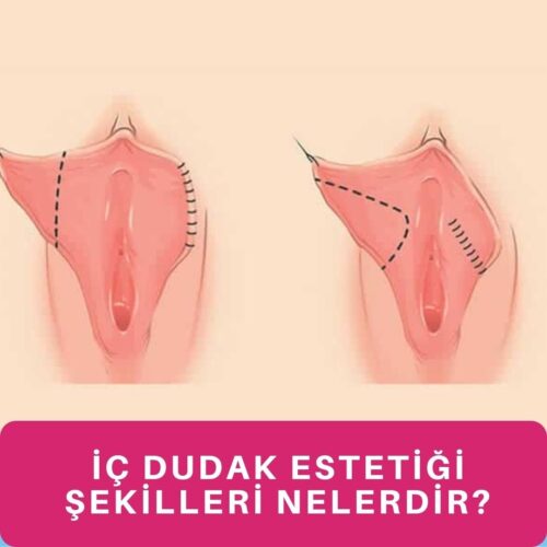 ic dudak estetigi genital estetik labioplasti ameliyati fiyatlari 3 500x500 - İstanbul genital estetik fiyatı